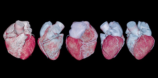 CTA Matches Invasive Angiography for Stratification of NSTE ACS Risk - Vimarsana News