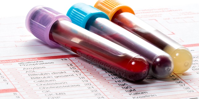 NT-proBNP Test Could Help Guide Hypertension Therapy: ARIC Analysis - Vimarsana News