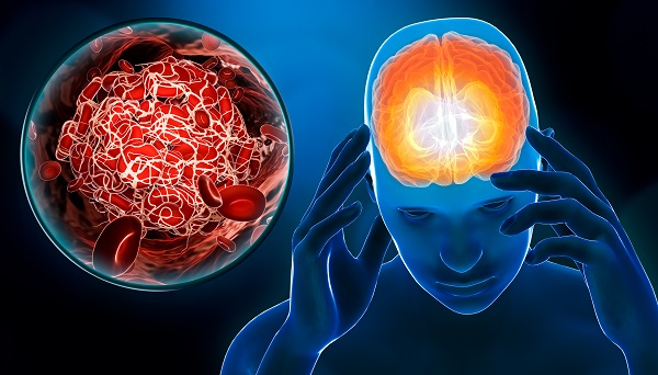 AHA/ASA Offers Advice on Rare Blood Clots Seen After Vaccines for COVID-19 - Vimarsana News