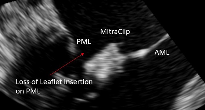 For Failed MitraClip, Next Procedure Might Depend on MR Etiology - Vimarsana News