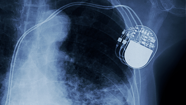 Extended DANISH Follow-up Supports ICD Benefits in Younger Nonischemic HF Patients - Vimarsana News