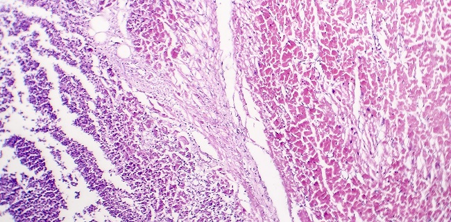 True Myocarditis Uncommon in COVID-19, Review Concludes.jpeg