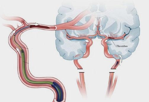 Does It Matter How Clot Is Removed In Acute Ischemic Stroke Maybe Not Tctmd Com