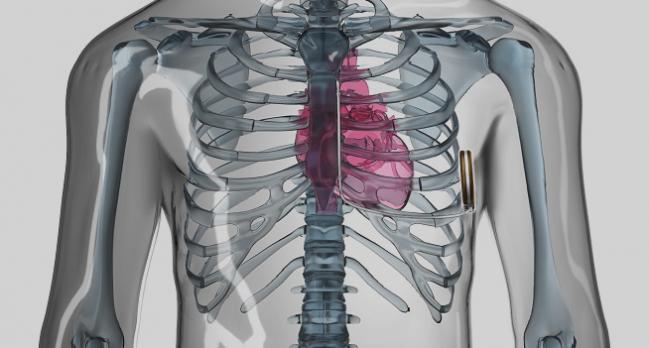 Subcutaneous Icd Holds Up Well Against Transvenous Devices Tctmd Com