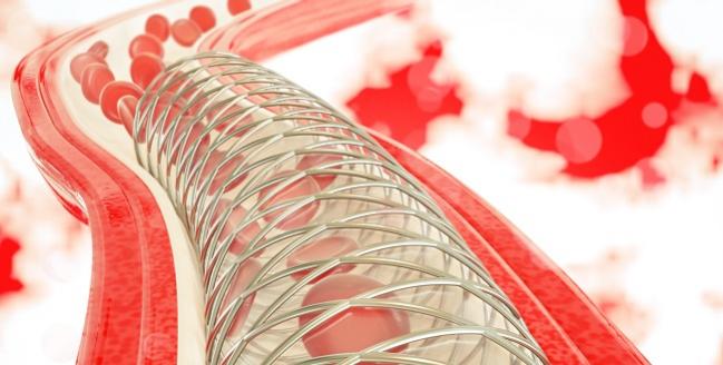 Stent Thrombosis May Be Presenting Feature Of Covid 19 Tctmd Com