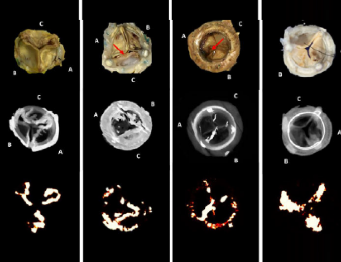 Can We Standardize The Definition Of Structural Prosthetic Valve Dysfunction Tctmd Com