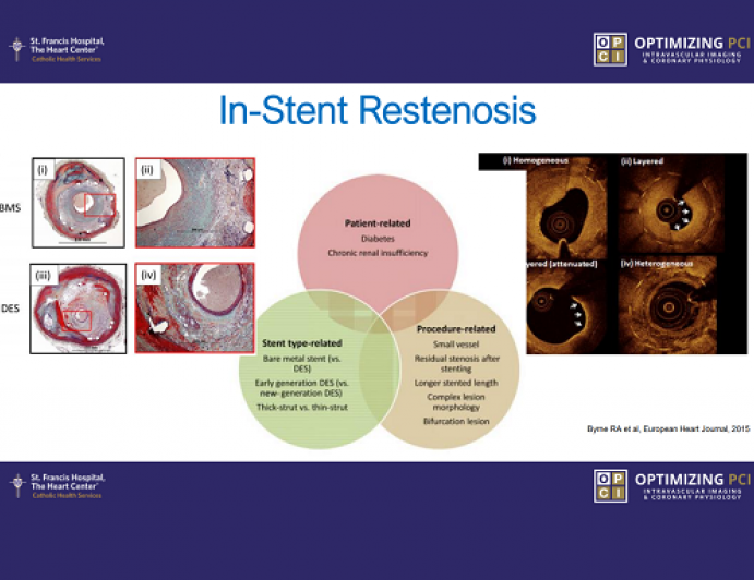 Stent failures Identifying causes of stent thrombosis and restenosis