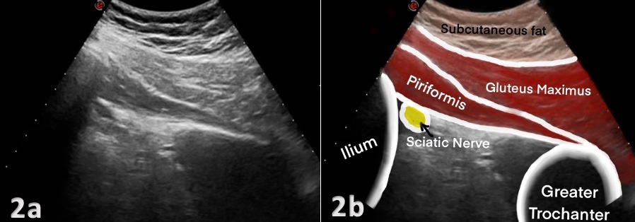 Piriformis Inj Piriformis Syndrome Injection