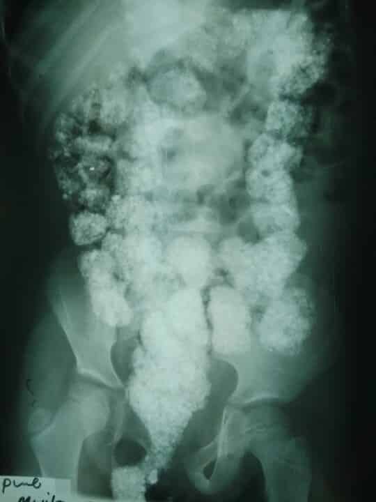 Intestinal obstruction caused by a large colorectal lithobezoar in a 7 ...