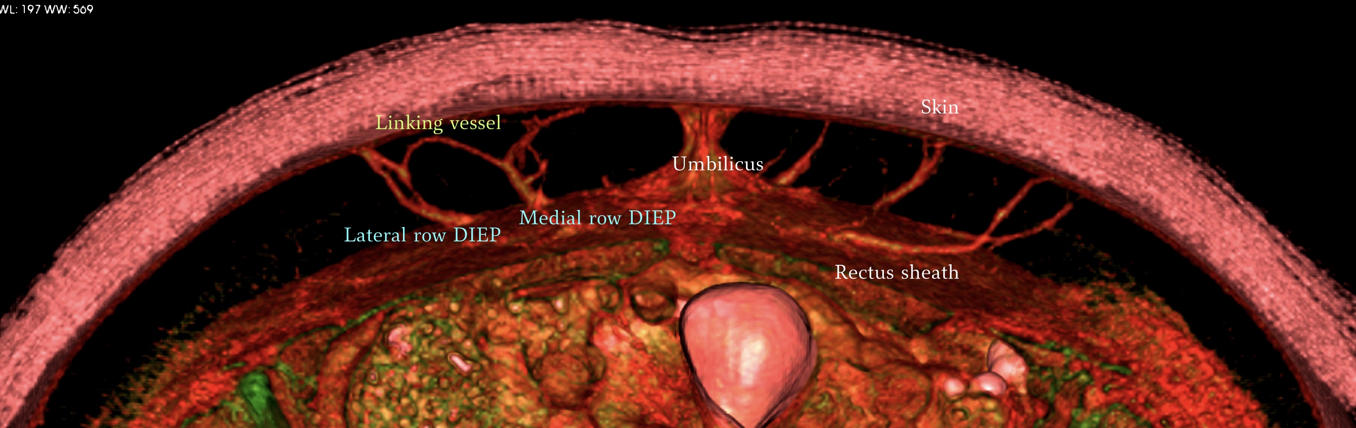 Imaging of perforasome territories: the evolution of techniques