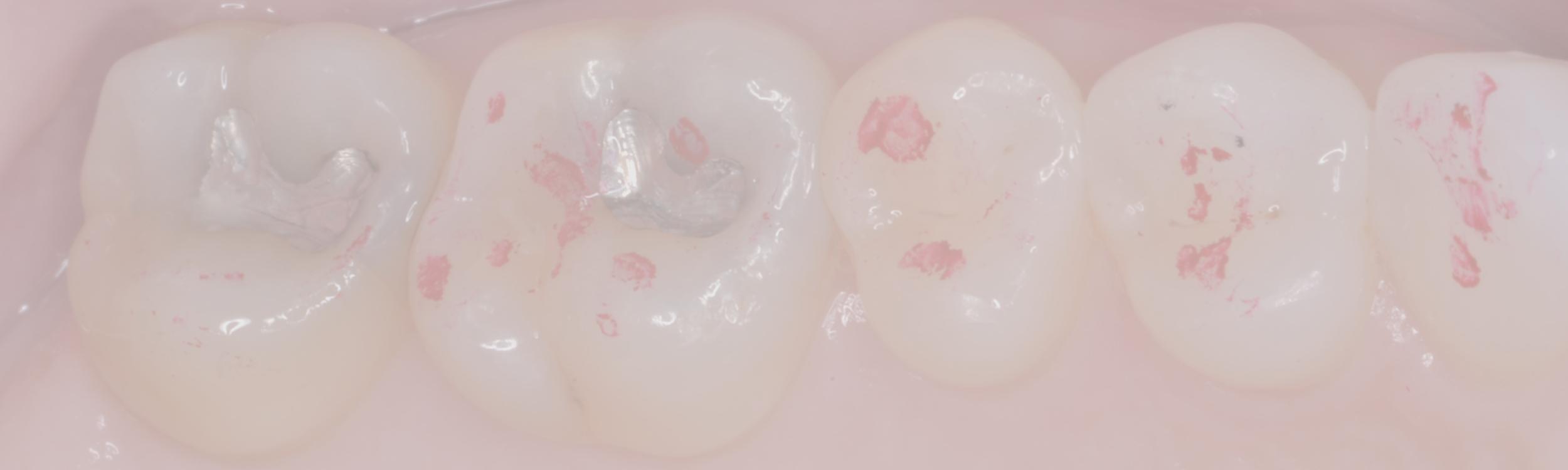 A Disclusion Time Reduction Randomized Controlled Occlusal