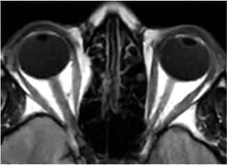 Case Report: Nasal Hypoplasia of the Optic Disc Reclassified to Septo ...