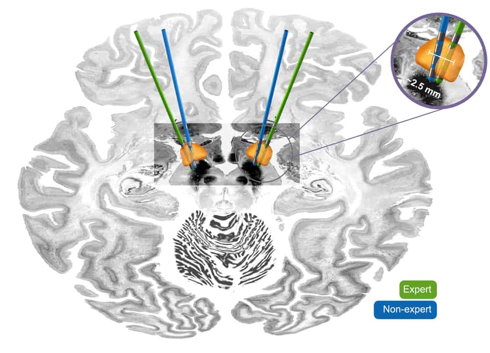 Lead-Tutor: An open-access educational resource for deep brain ...