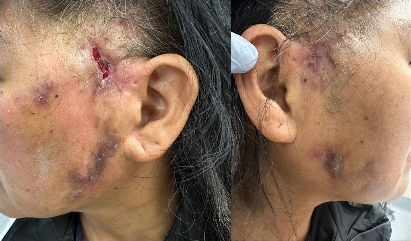 Mycobacterium abscessus post-facelift surgery: a case report