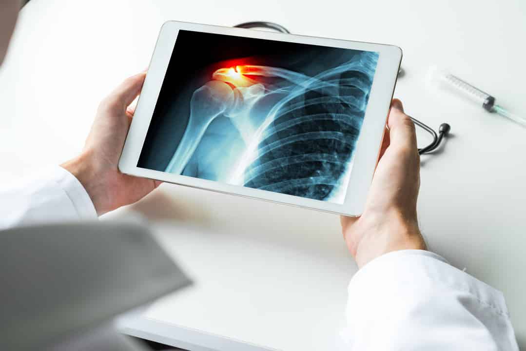 Inset Glenoid Technology A Paradigm Shift in Shoulder Replacement