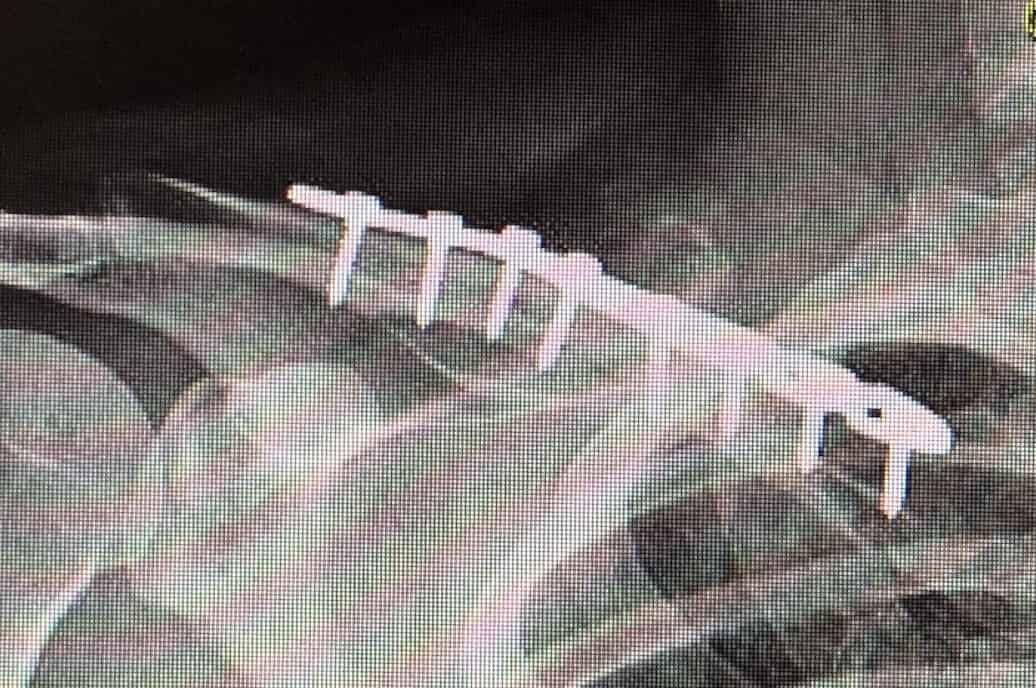 Right Clavicle Fracture Cpt Code