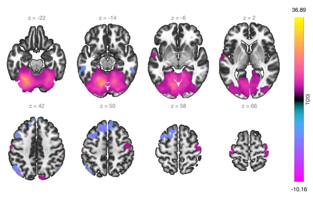 Resting-state functional connectivity in children and adults with ...