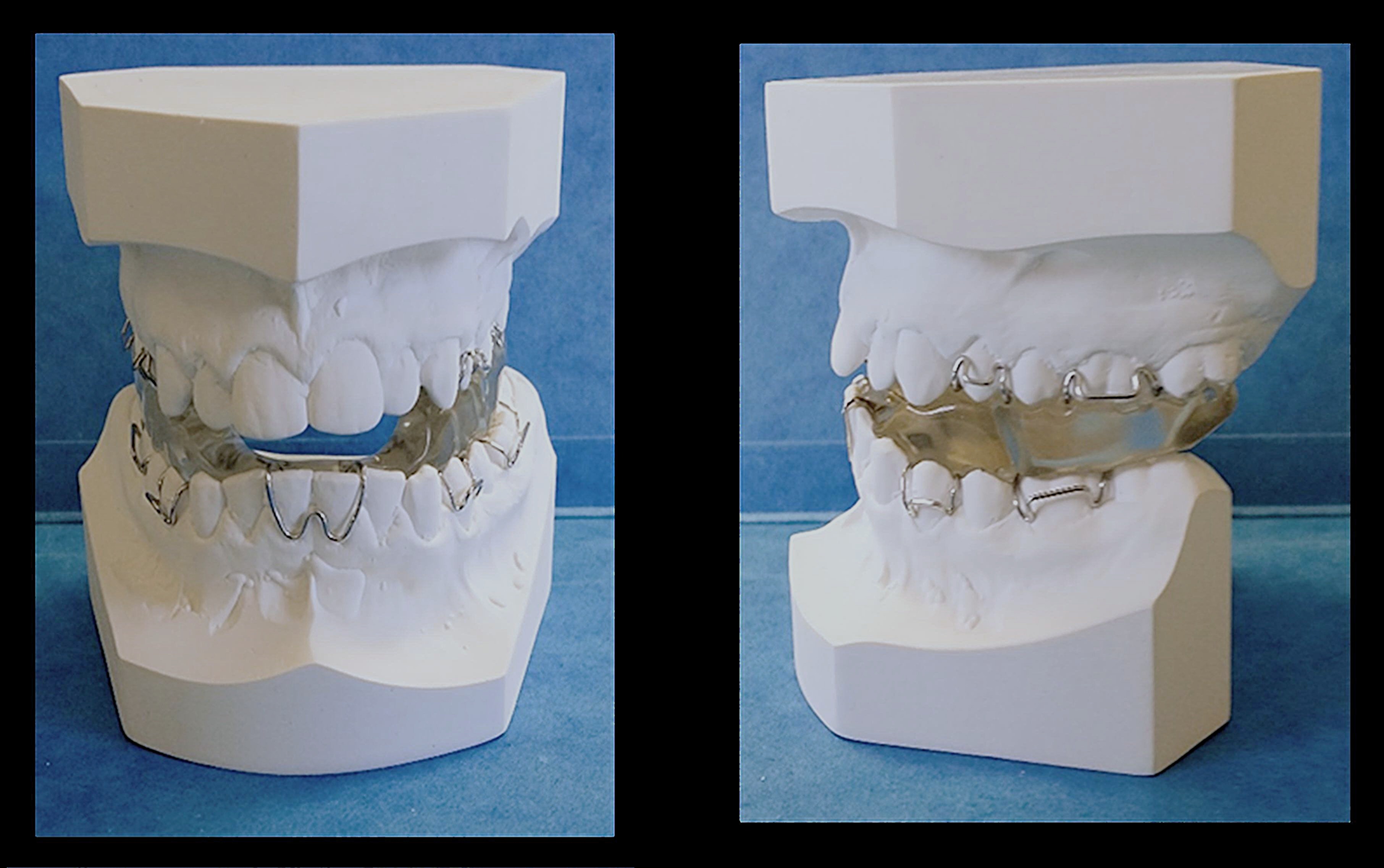 Impact of initial correction of Class II division 1 malocclusion