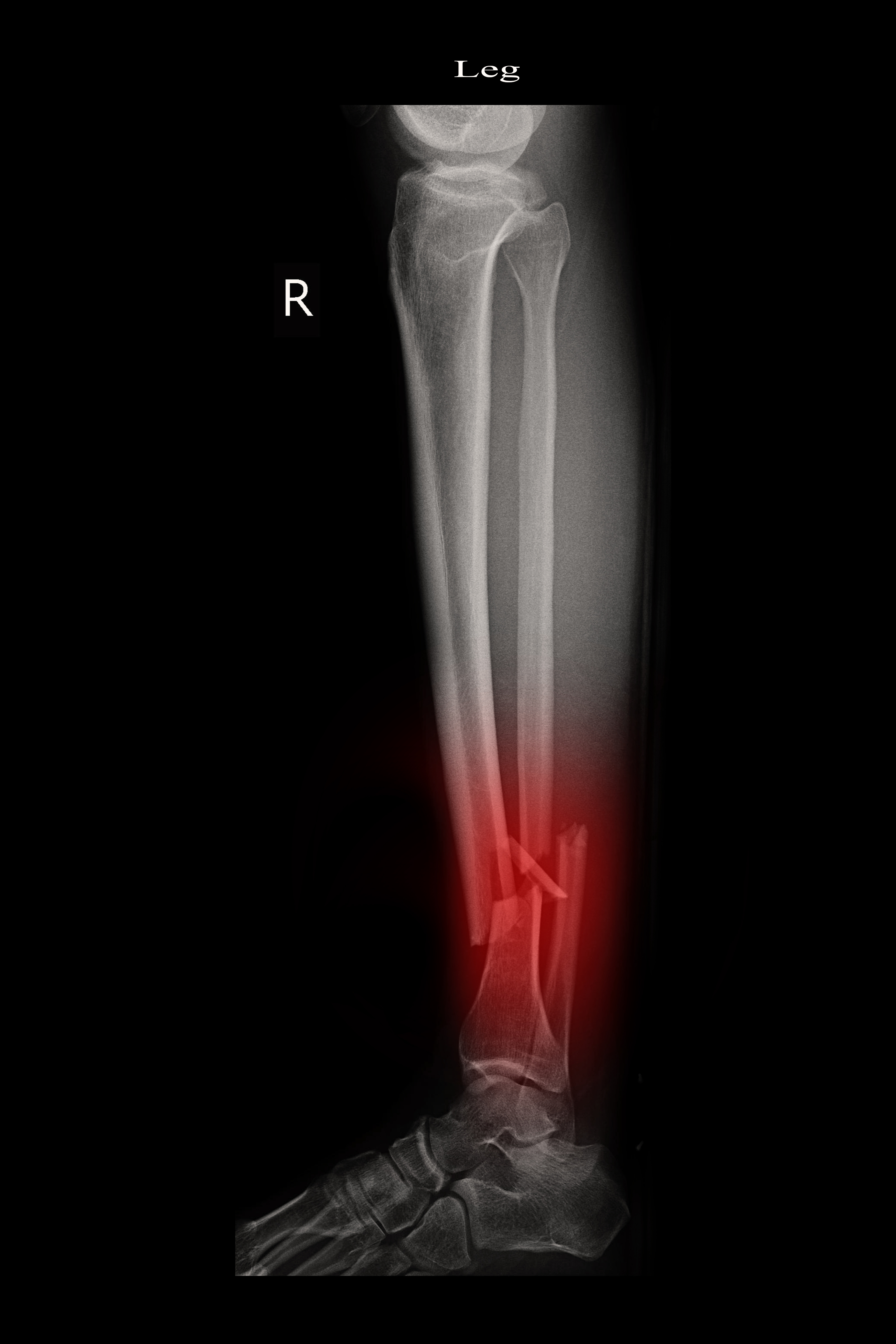 Wound complications, infections and nonunions do not increase with open  reduction of tibia shaft fractures treated with intramedullary devices |  Published in Journal of Orthopaedic Experience \u0026 Innovation, image size:3200x4800