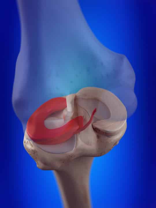 Management of a Lateral Meniscus Tear with BucketHandle Displacement