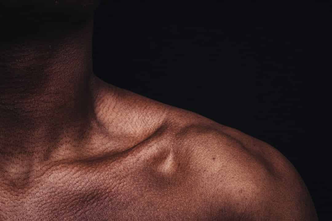 Upper Extremity Superficial Vein Thromboses Presenting as Acute Neck
