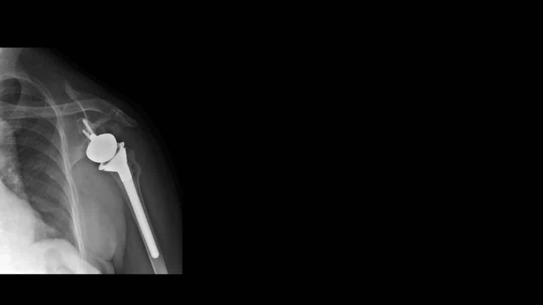 Trends in Reverse Total Shoulder Arthroplasty: How the Early Trends in ...