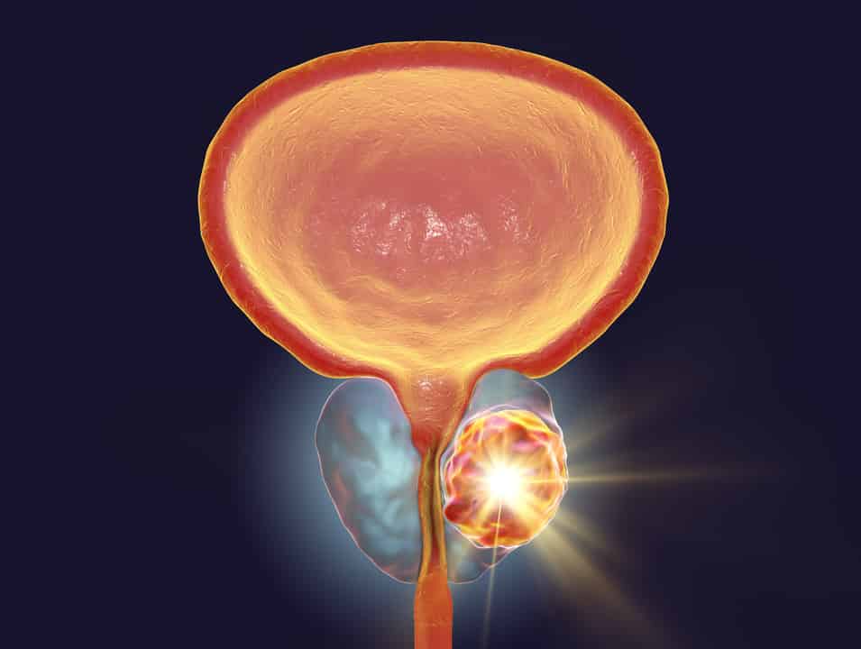 Artificial Intelligence Clinical Application in Prostate Cancer ...