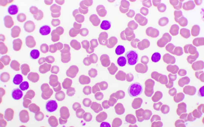 CLL and Lymphoma Studies at EHA2021 and 16ICML Published in