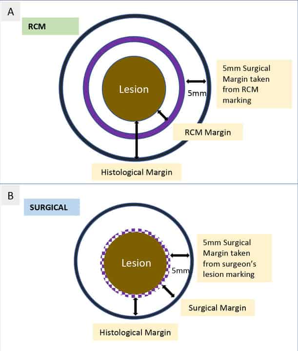 Comparing preoperative mapping with reflectance confocal microscopy to ...