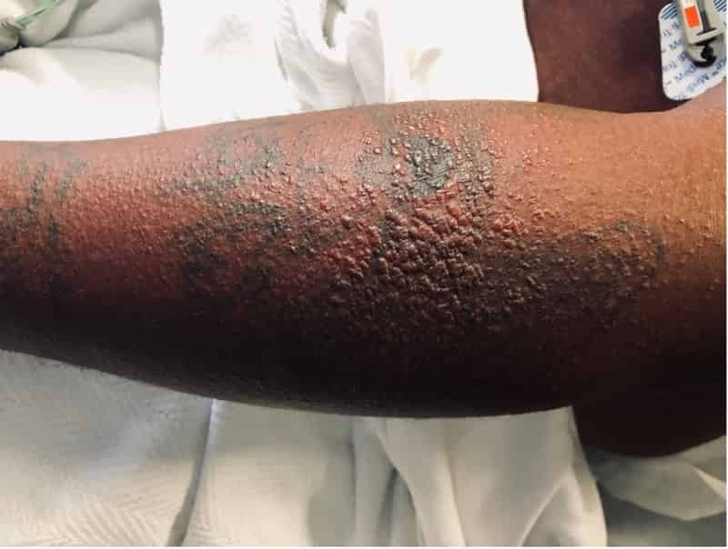 dress syndrome Atypical Presentation of DRESS Syndrome With Associated Acute Kidney Injury  in a Male Patient Following Vancomycin Exposure