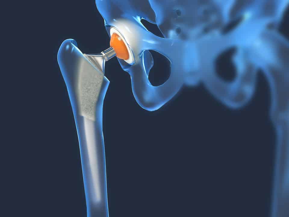 Revision Total Hip Arthroplasty using a Direct Anterior Approach in a ...
