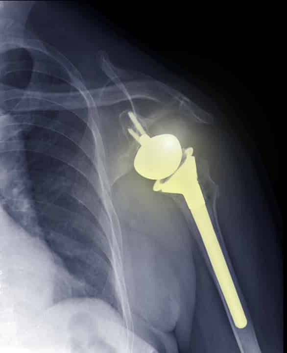 The Use of Virtual Reality Training in Preparation for Reverse Total