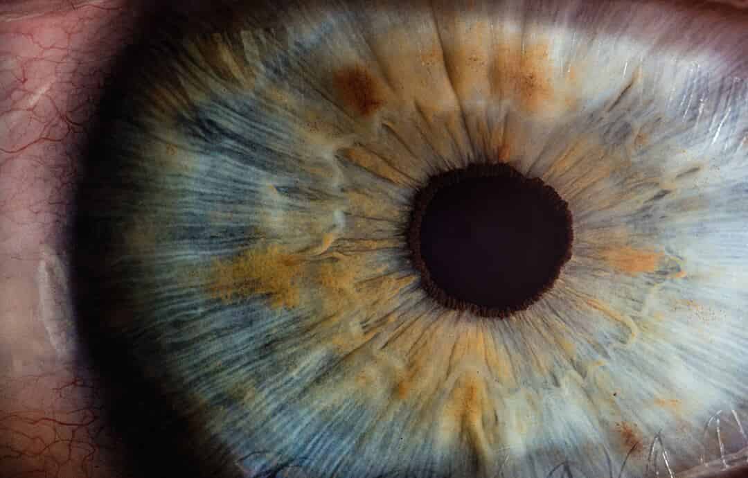 Purtscher-like Retinopathy in a Patient with Acute Pancreatitis: A Case ...