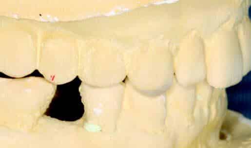 Canine ramps | Published in Journal of the Irish Dental Association