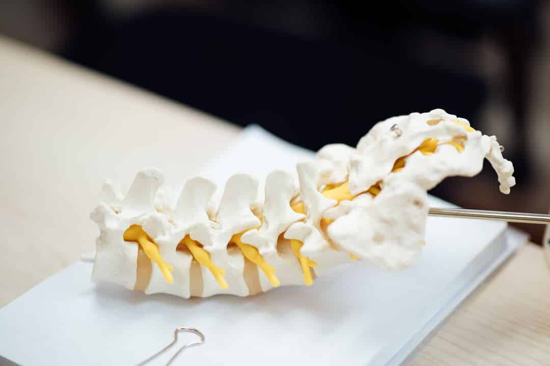 Neuroforaminal Stenosis in the Lumbosacral Spine: A Scoping Review of ...