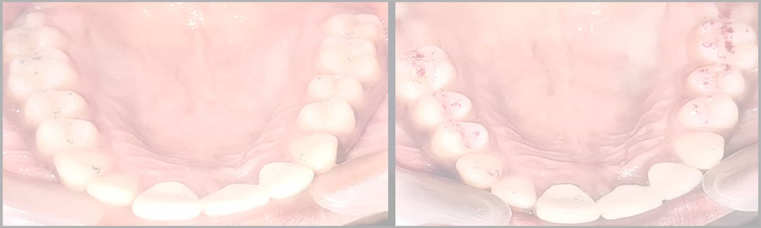 Prosthodontists' clinical accuracy in selecting high force