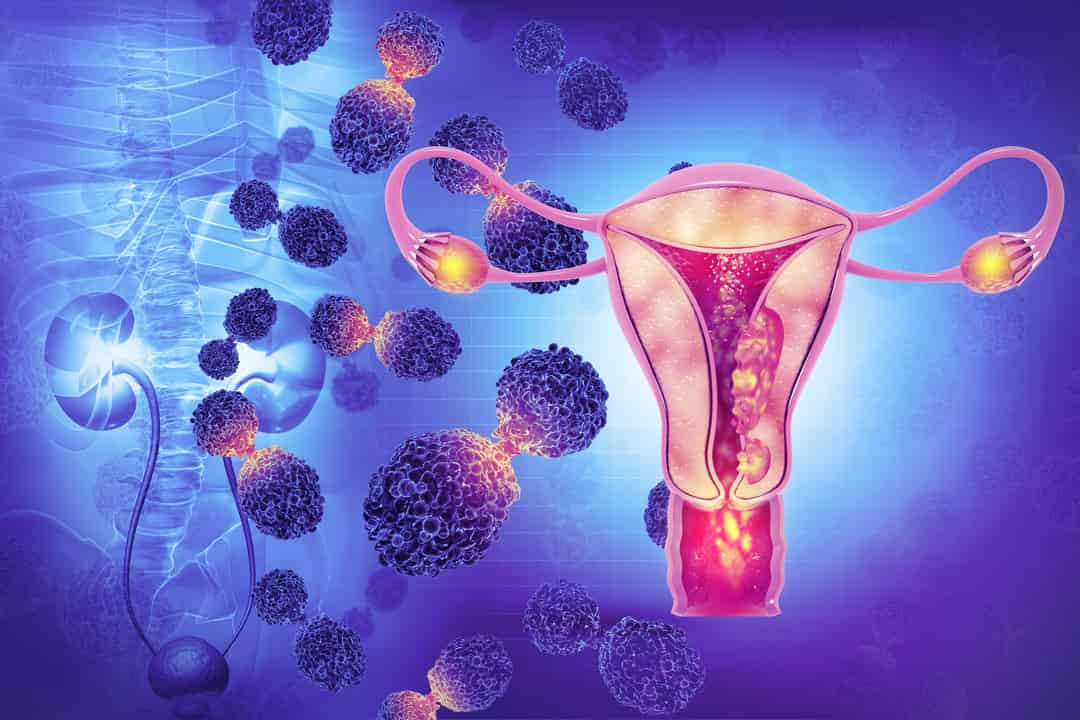 Immune Checkpoint Inhibitors in Endometrial Cancer: The New Paradigm of ...