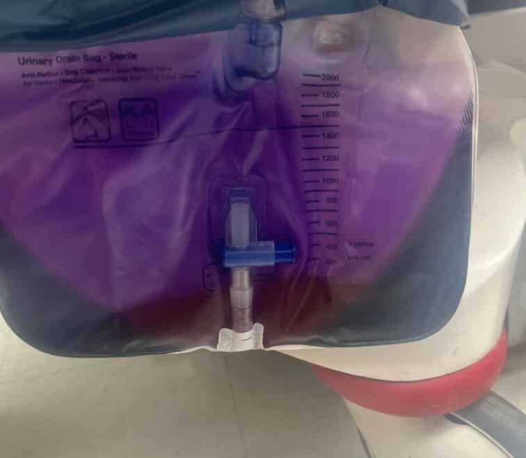 Purple Urine Bag Syndrome Published in Journal of the Mississippi State Medical Association