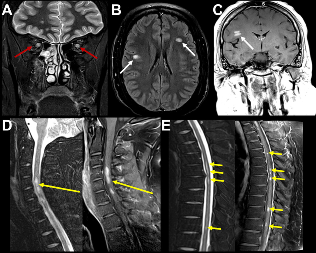 A close-up of a brain mri AI-generated content may be incorrect.