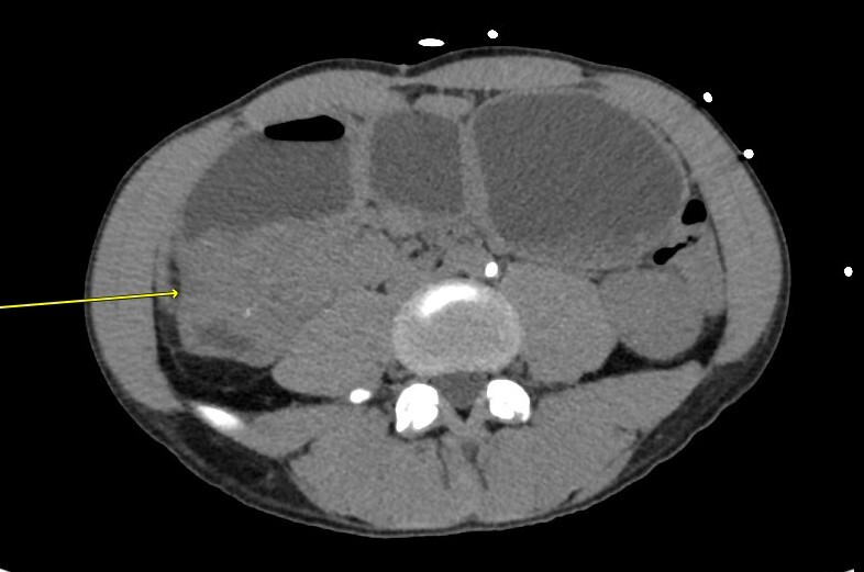 A close-up of an x-ray of a body AI-generated content may be incorrect.