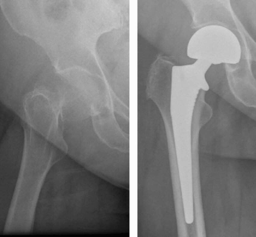 Neck of femur fracture and hemiarthroplasty | Download ...