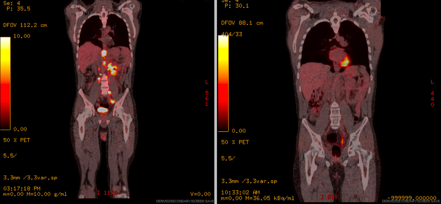 Therapeutic challenges in Primary Refractory stage IV ALK + Large B