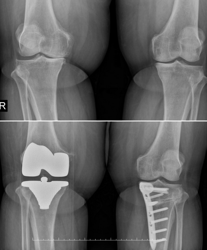 SIMULTANEOUS CONTRALATERAL HIGH TIBIAL OSTEOTOMY DURING TOTAL KNEE