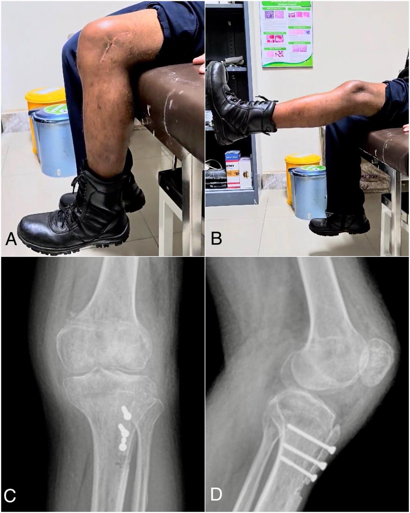 A close-up of a person's knee Description automatically generated