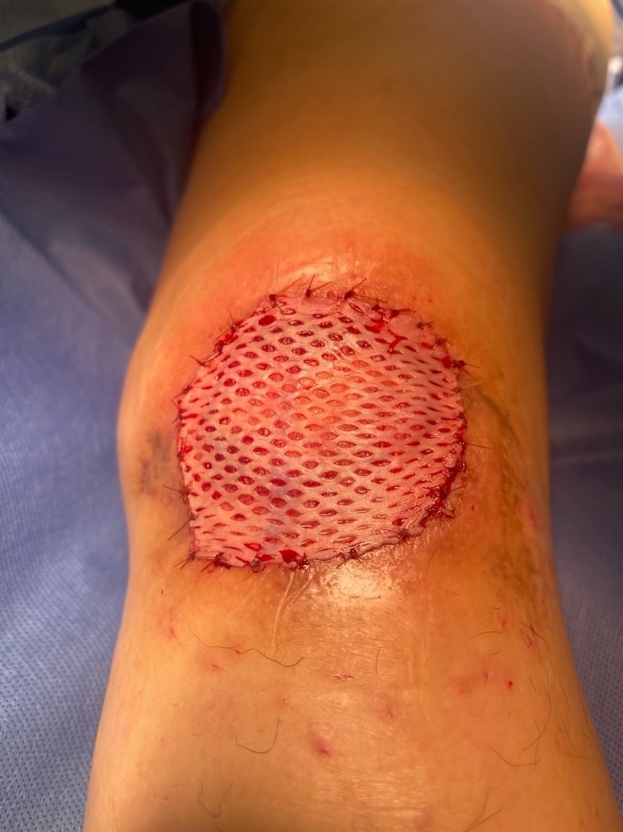A wound on a knee Description automatically generated