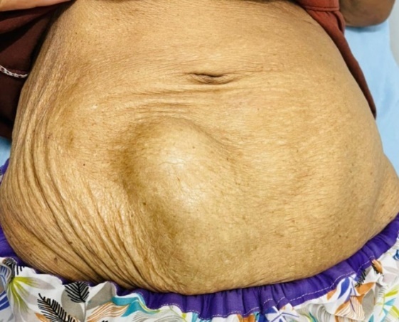 The lump she presented with 