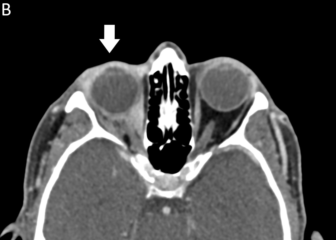 Figure B