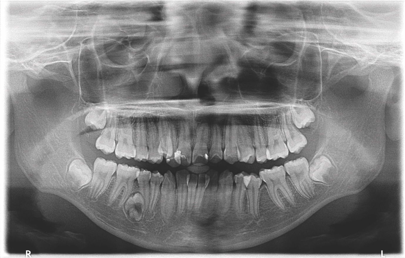 Metachronous supernumerary teeth in a non-syndromic patient