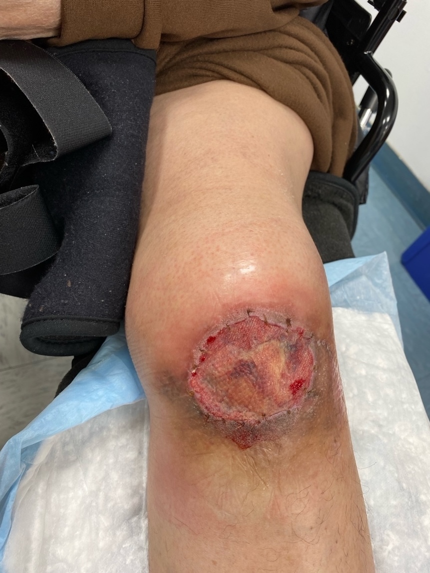 A knee with a cut on it Description automatically generated