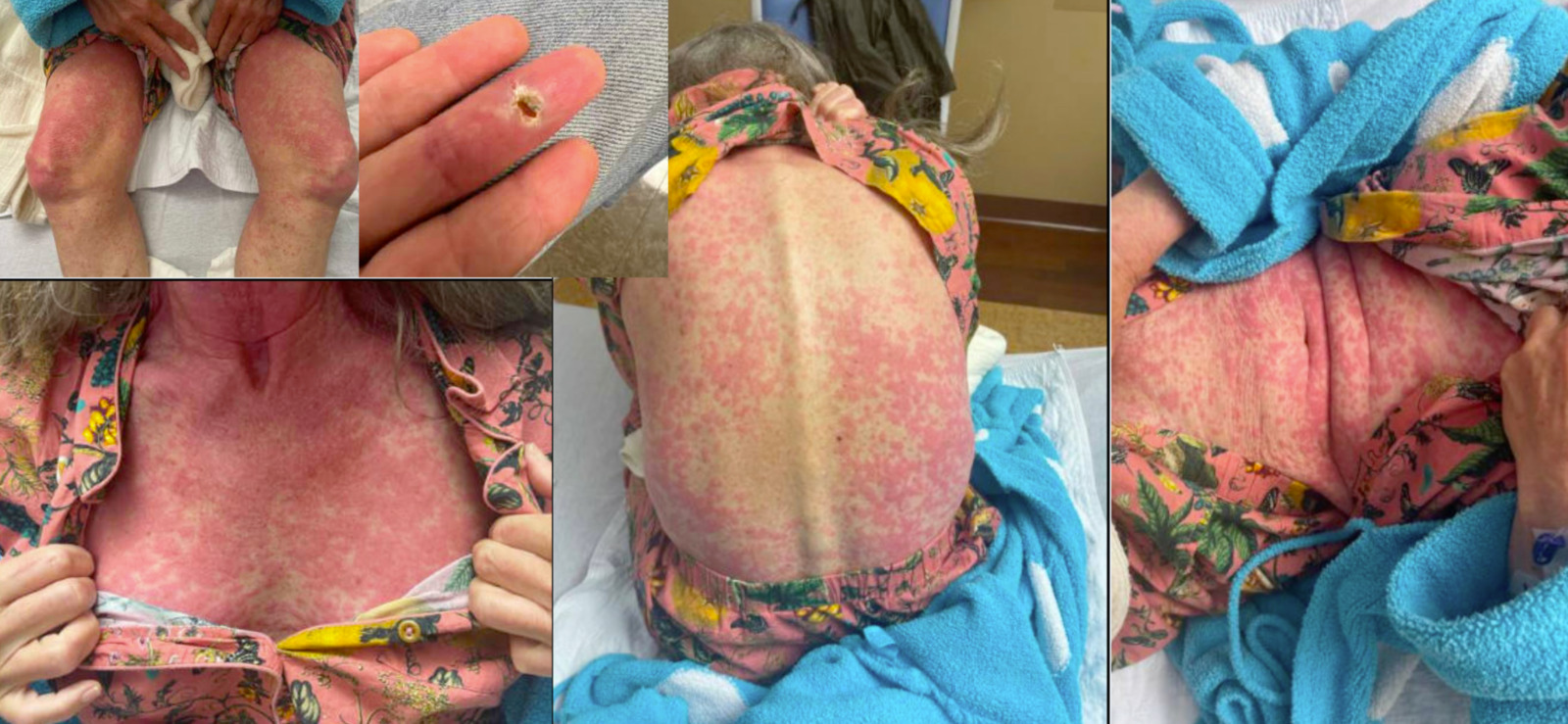 Drug Reaction with Eosinophilia and Systemic Symptoms Secondary to Ethambutol